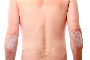 Memahami Gejala Psoriasis Dan Cara Mengontrol Kekambuhannya